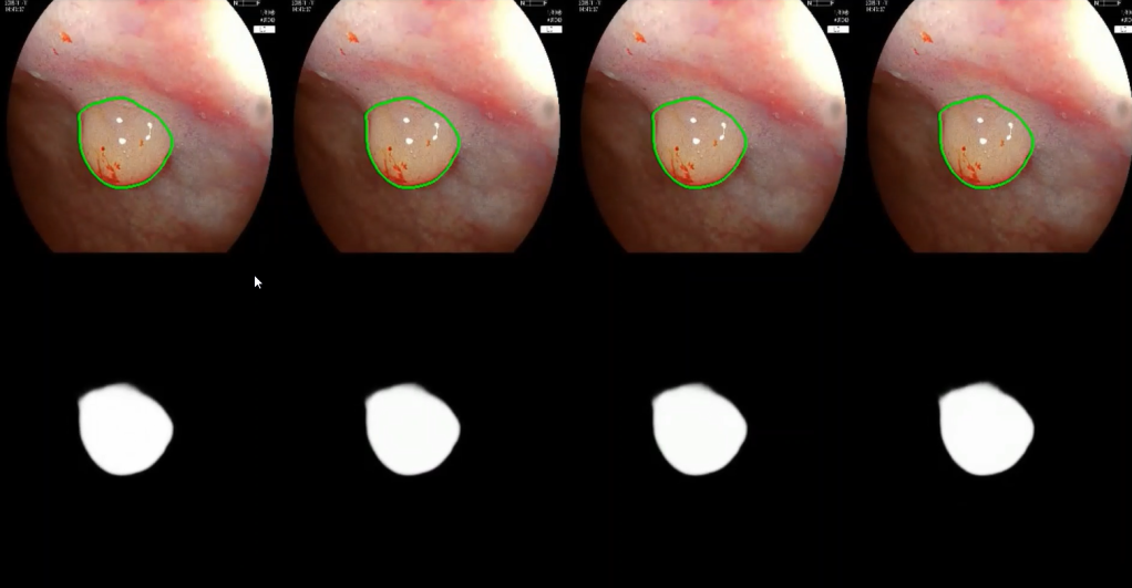 Hình ảnh polyp do AI phát hiện và đánh dấu.